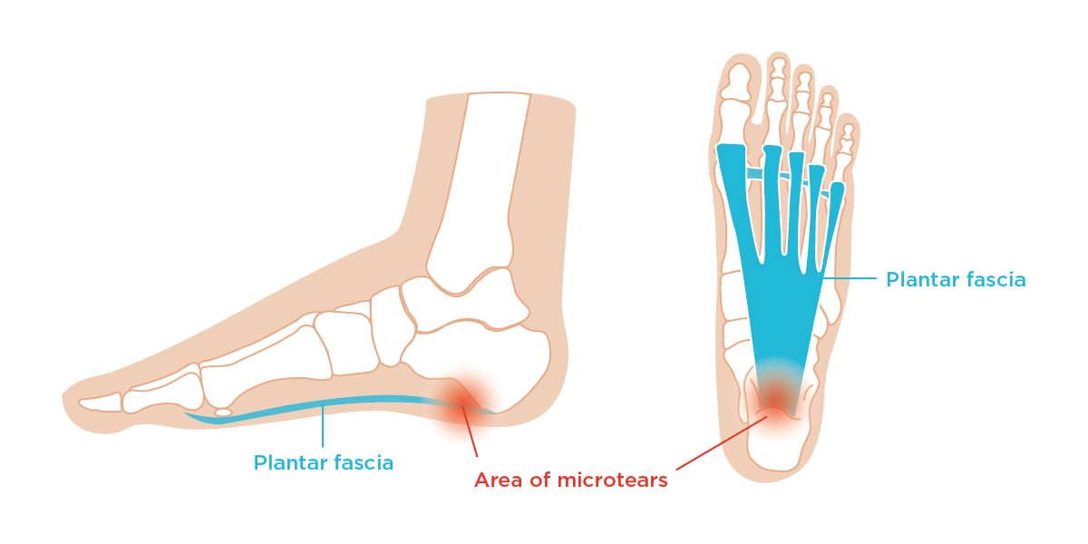 Plantar Fasciitis location