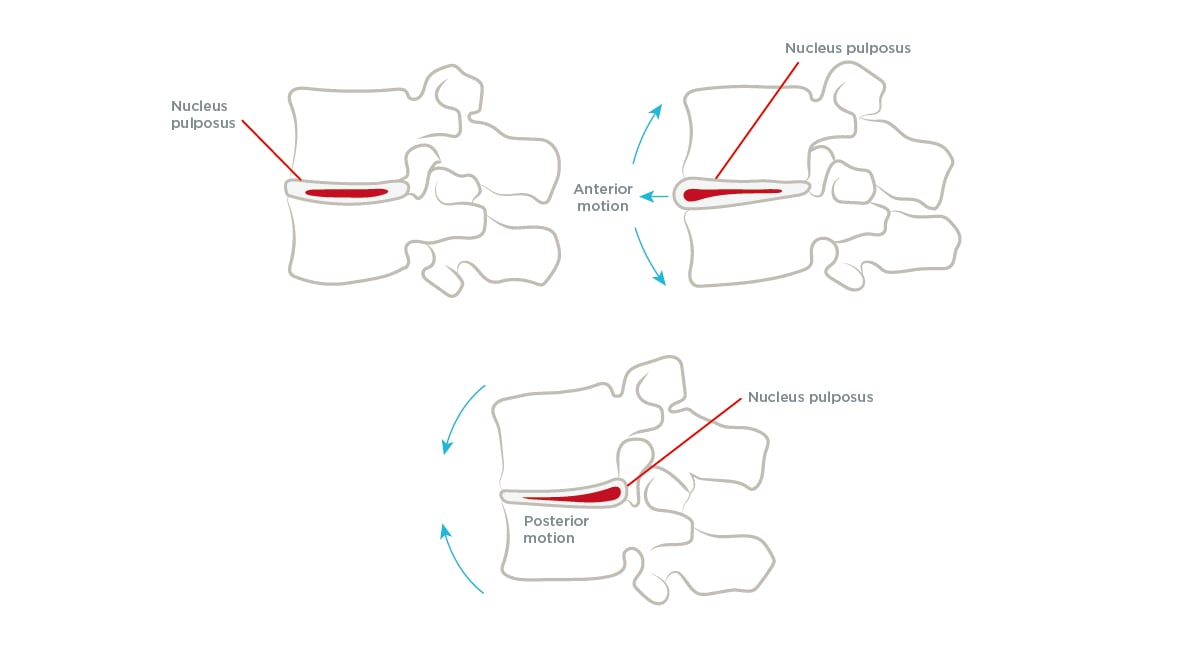 Exercise for Lumbar Disc Disorder